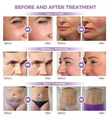 New Design 7d Ultralift 360 Pain less Hifu Face Lifting System Weinkle Removal Smas Body Weight Loss Vmax Skin Lifting Slim Machine Factory Supply