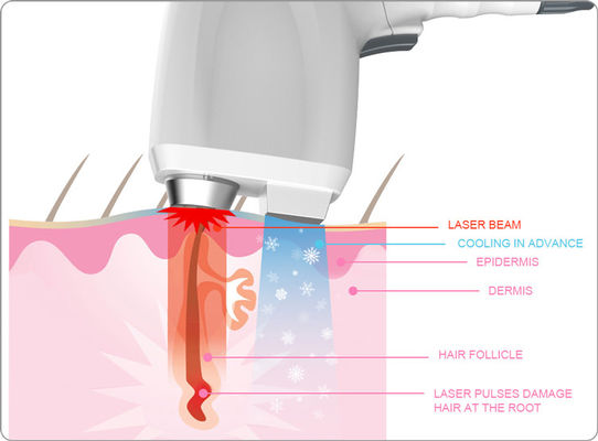 Diode Laser+Alexandrite laser+Nd YAG Q swtiched Laser 3 in 1 laser System