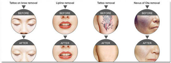 532nm 1064nm ND:YAG laser tattoo removal machine qmlaser
