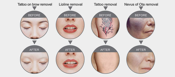 Q-Switched Nd:YAG Laser Tattoo Removal Equipment qmlaser
