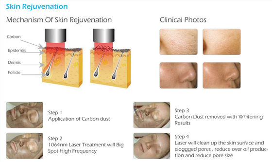 FDA approved Picosure Laser 755nm Professional Tattoo Removal Machine